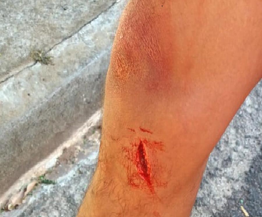 Gari se fere gravemente com garrafa quebrada dentro do lixo doméstico