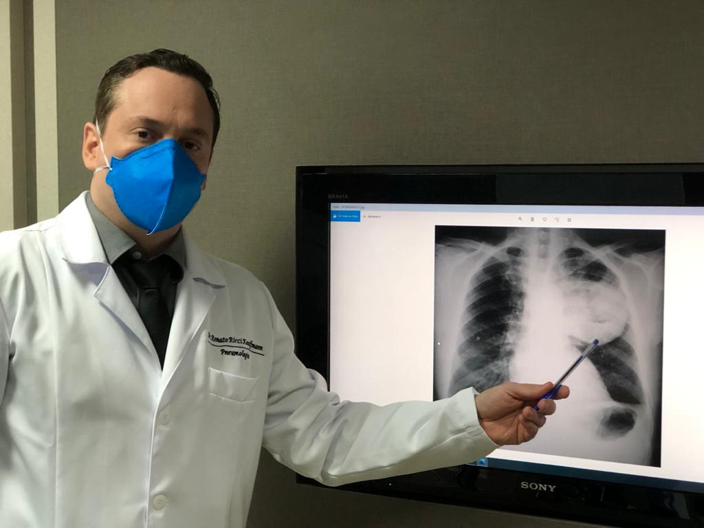 Especialista alerta para a incidência de câncer de pulmão em pessoas que fumam