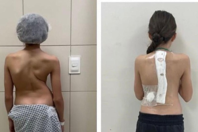 Jornal Ilustrado - Paraná é referência em cirurgias de deformidade da coluna vertebral