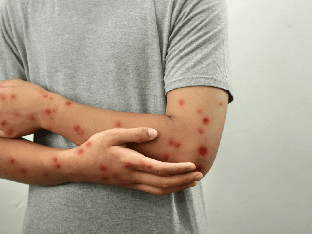 Paraná confirma primeiro caso de mpox em 2026; Brasil já soma 88 registros